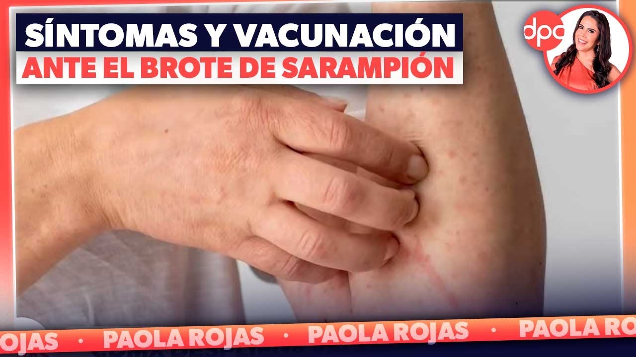 Síntomas y vacunas: lo esencial ante el brote de sarampión | DPC con Paola Rojas