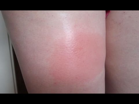 Koślawe zniekształcenie nóg u dziewcząt Dlaczego boli zatrzymać w pobliżu kości