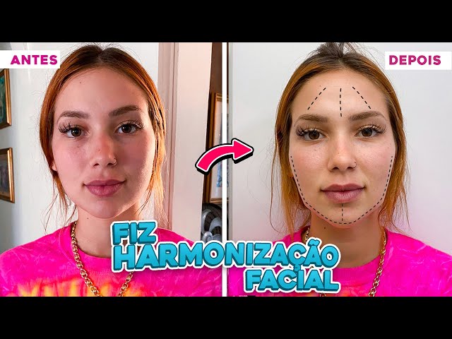 PRIMEIRA VEZ FAZENDO HARMONIZAÇÃO FACIAL!! DEU MUITA DIFERENÇA <img src=