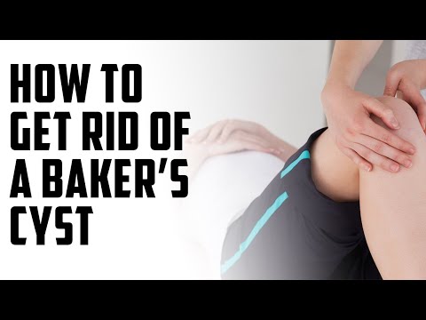 how do you get rid of a baker's cyst | A Episode 65