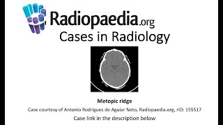 Metopic ridge (Radiopaedia.org) Cases in Radiology