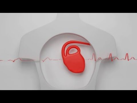 How Cardioversion Procedure Treats Atrial Fibrillation? | How To Prevent this Heart Condition?