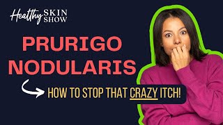 What is PRURIGO NODULARIS: Treatment to STOP the CRAZY ITCH | Shawn Kwatra