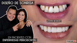 Diseño de Sonrisa en pacientes con Enfermedad Periodontal ¿Cómo se hace - Odontología Láser.