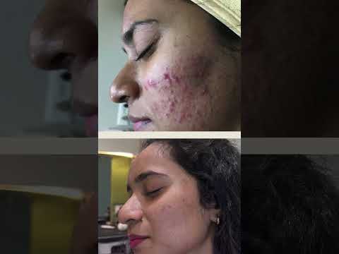 Clear Skin Chronicles: Your Acne-Free Journey with The Skin Firm, Pune | Best Skin Clinic in Pune