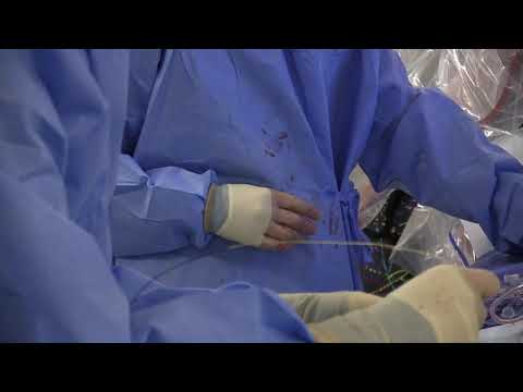 Guidewire Selection for Coronary CTO Procedures at the University Of Colorado Hospital