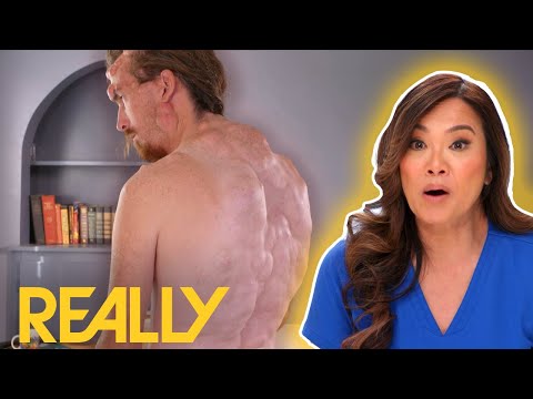 "I Have Over 400 Tumours On My Body" | Dr Pimple Popper