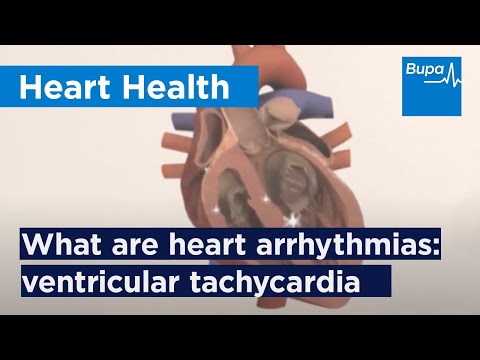 What are heart arrhythmias: ventricular tachycardia | Bupa Health