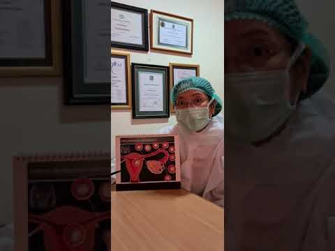 Angkat rahim tidak akan membuat menopause dini