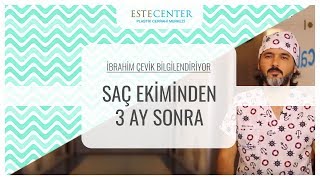 İbrahim Çevik Bilgilendiriyor - Saç Ekiminden 3 Ay Sonra