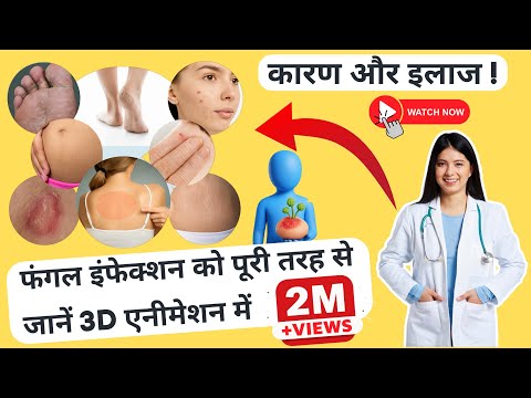 Ayurvedic malam gujrat skin fungal in surat ,ayurvedic malam...