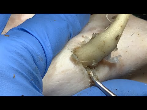 🔴 Professional DR LEE’S ULTIMATE ZITPOPPER Sharp Ingrown Pedicure ✧ 4658