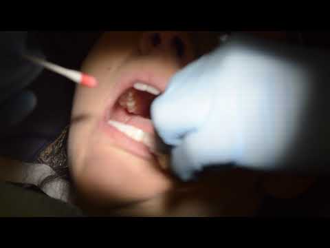 Mental:Incisive Injection