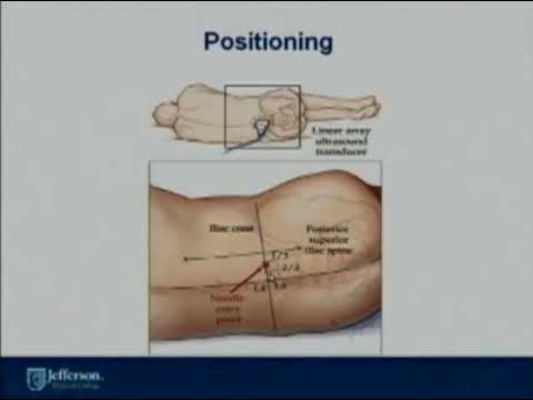 Ultrasound Guided Nerve Blocks of Lower Extremity