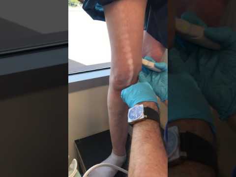 EVLT R Great Saphenous Vein