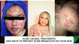 Watch This Before You Treat That PIMPLES And ACNE (Acne: causes,treatment,prevention).