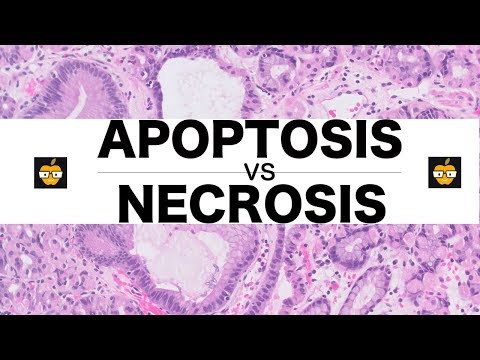 Apoptosis (Intrinsic, Extrinsic Pathways) vs. Necrosis