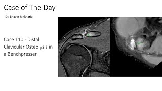 Case of the Day - 110 - 2025 09 29 - Distal Clavicular Osteolysis in a Benchpresser
