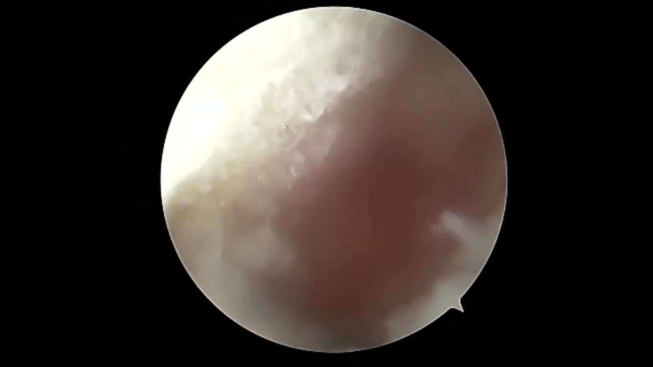 Dr. Garcia’s 2026 lateral meniscus transplant video