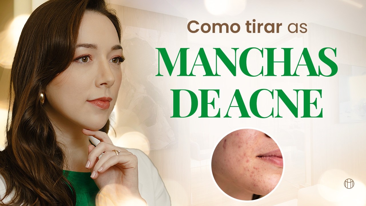 Como TIRAR as MANCHAS de ACNE? I Te explico nesse vídeo!