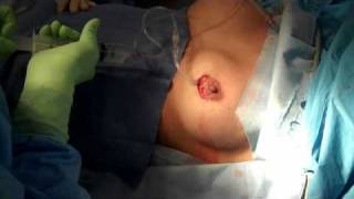 preview picture of video 'www.breast enlargement-westport.com'