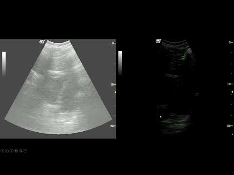 Introduction to Point of Care Ultrasound