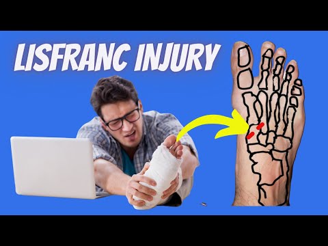Lisfranc Injuries: EVERYTHING You Need to Know!