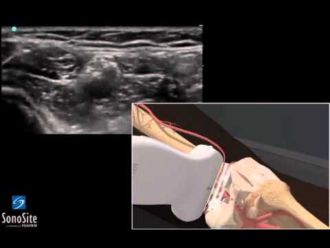 3D Lehrvideo: Ultraschallgestützte Popliteal Sciatic regionale Nervenblockade