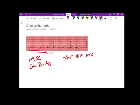 Sinus Arrhythmia - Dr Jamal USMLE -  cardiology ECG lecture