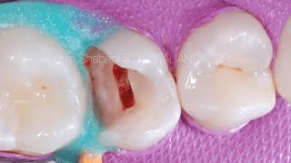 Operative Clinical - Pulp Exposure