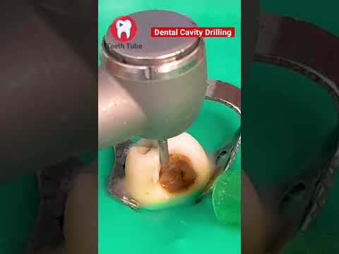 Dental Cavity Drilling #shorts