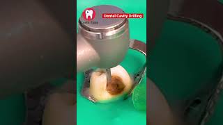 Download lagu Dental Cavity Drilling #shorts mp3