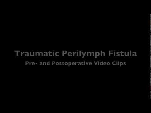 Perilymph Fistula