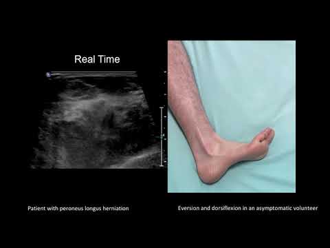 Dynamic ultrasound imaging of peroneus longus muscle herniation