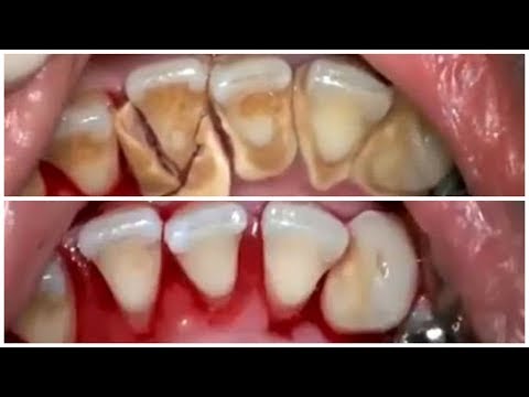 Di mana Anda dapat menurunkan berat badan dengan 10 kg selama 2 minggu Ini membantu untuk menghapus hulahup perut kendur