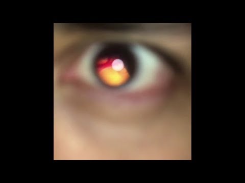 Smartphone Direct Ophthalmoscopy Image