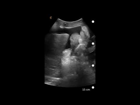 Image Interpretation: Ascites