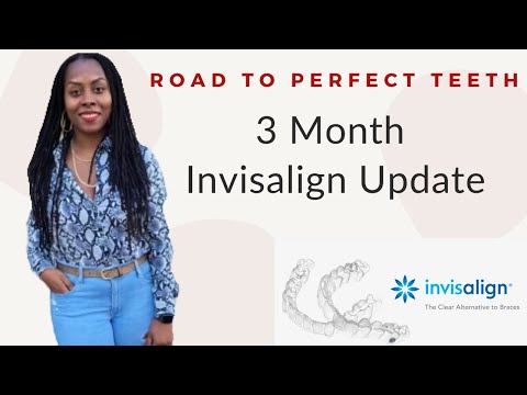 My Invisalign Journey 3 Month Update| What You Should Know | Invisalign Vs Byte