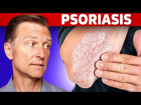 , title : 'Psoriasis Treatment – The Best 3 Remedies for Psoriasis – Dr.Berg'