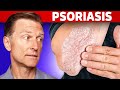 Psoriasis Treatment The Best 3 Remedies For Psoriasis Dr Berg