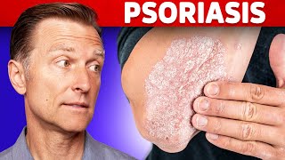 Psoriasis Treatment – The Best 3 Remedies for Psoriasis – Dr.Berg