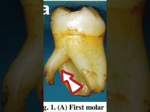 2 Tips for Mandibular Molar Root Canals…