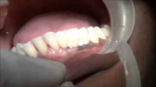 preview picture of video 'cementation of PFM ceramic bridge   Implant supported'