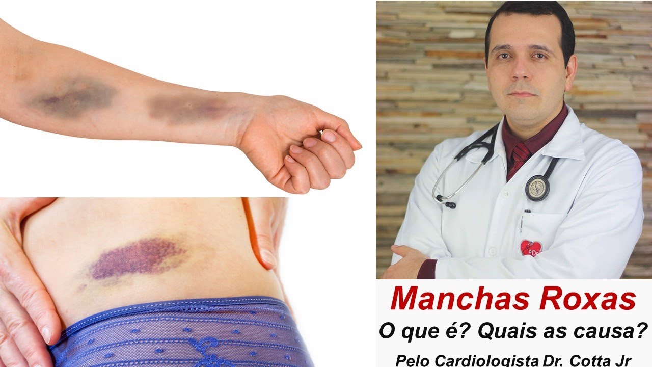 Manchas roxas no corpo: O que são? Quais as causas? Devo me preocupar?