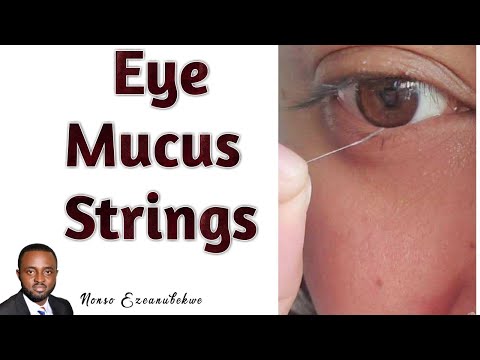 Eye Mucus Strings || Mucus Fishing Syndrome || Causes and Treatment