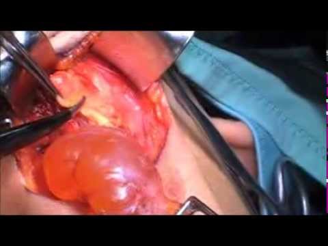 Che vi aiuterà con dolore lombare nelle donne in gravidanza Articolazioni video hondroprotektory