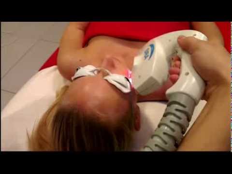 Laserowa usuwanie przebarwień i naczynek, pajączków