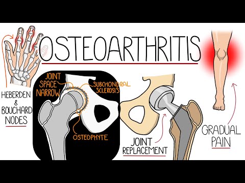 Osteoarthritis Explained Clearly