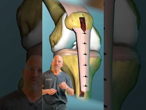 ACL Fixed with Patellar Tendon #shorts