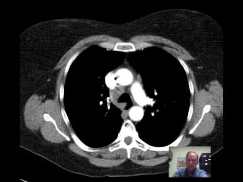CT Chest Lung Nodule Discussed by Radiologist